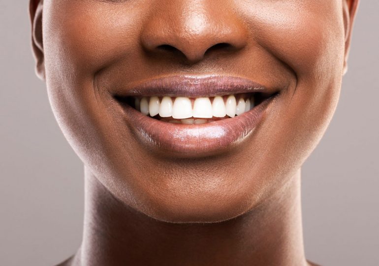 Teeth Whitening Jubilee Dental Clinic